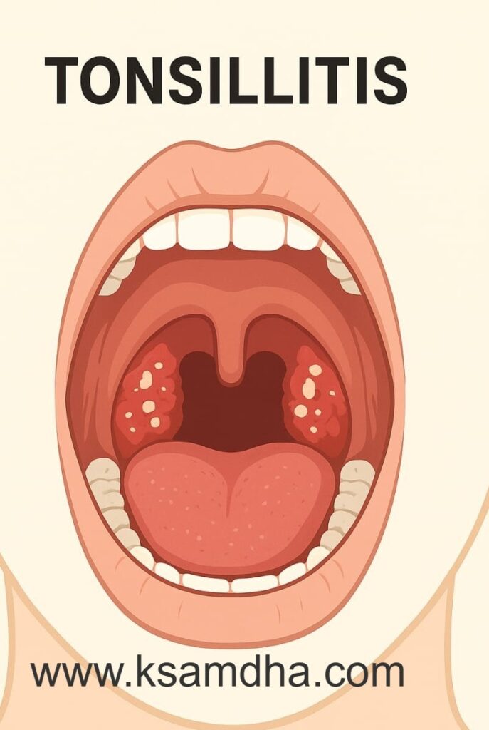 Tonsillitis